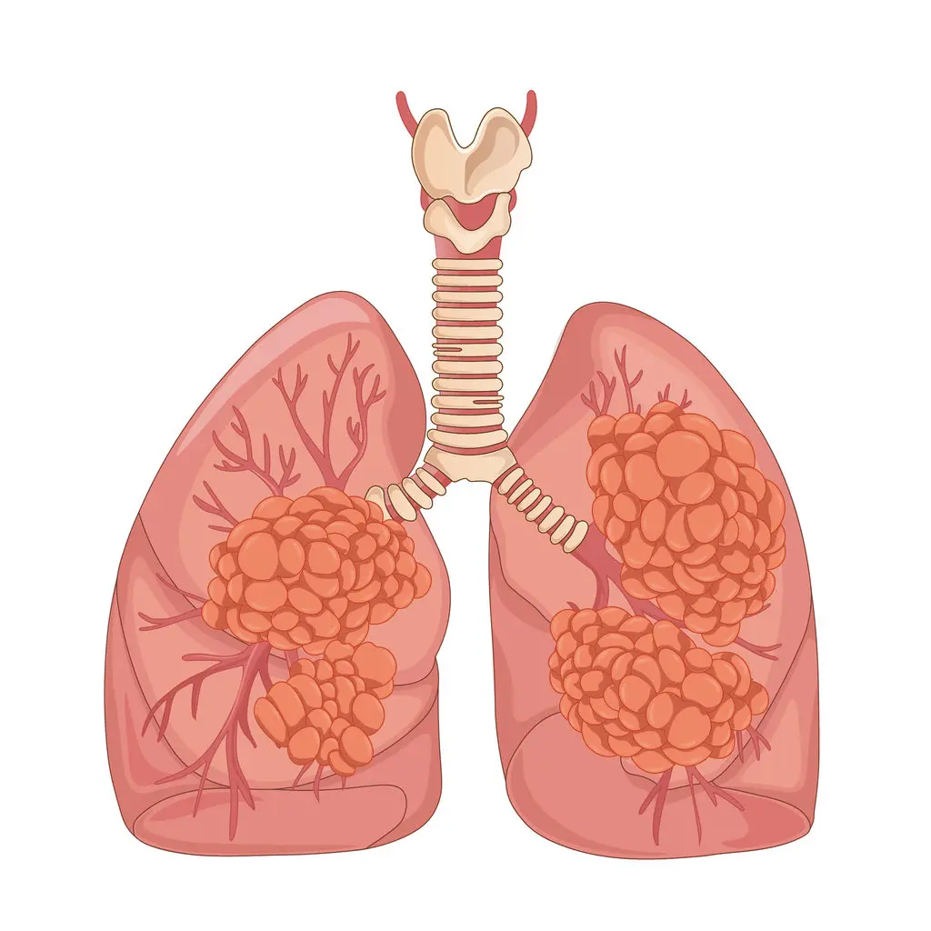 Lung Cancer