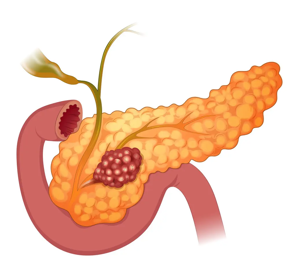 Pancreatic Cancer