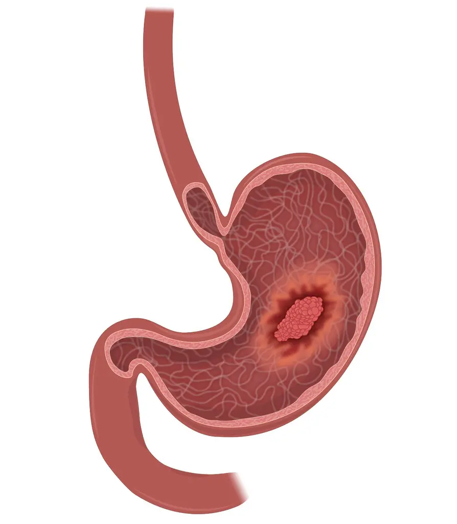 Gastrointestinal Cancer