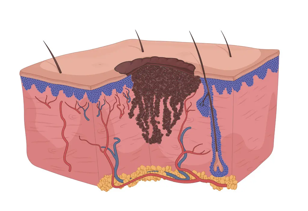 Skin Cancer