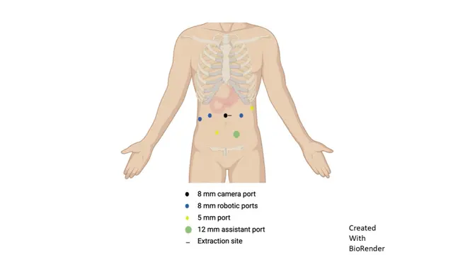 Robotic Duodenal Sleeve Resection for Gastrointestinal Stromal Tumor with Rare Exon 8 KIT Mutation Following Neoadjuvant Imatinib