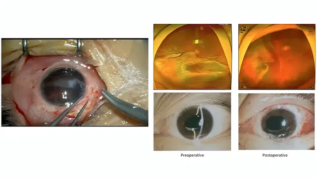 Implantation Protocol of the Foldable Capsular Vitreous Body for Complex Vitreoretinal Surgery