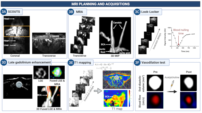 MRI planning and acquisitions: SCOUTS, MRA, Look-Locker, gadolinium enhancement, T1 mapping, vasodilation.
