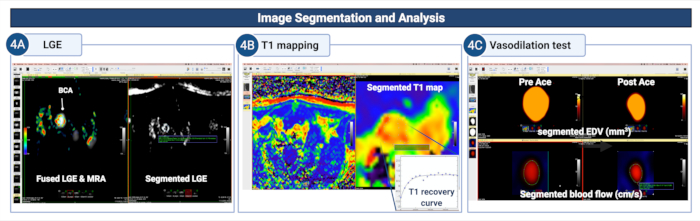 Image segmentation: LGE, T1 mapping, vasodilation test in MRI analysis, showing segmented data results.