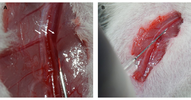 Surgical procedure on blood vessel; incision showing artery exposure and instrument in use.