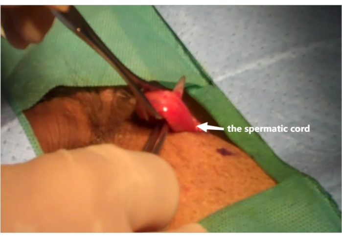 figure-results-1 Cerrahi anatomi: spermatik kordu vurgulayan vazektomi prosedürü; Tıp Eğitimi Diyagramı.