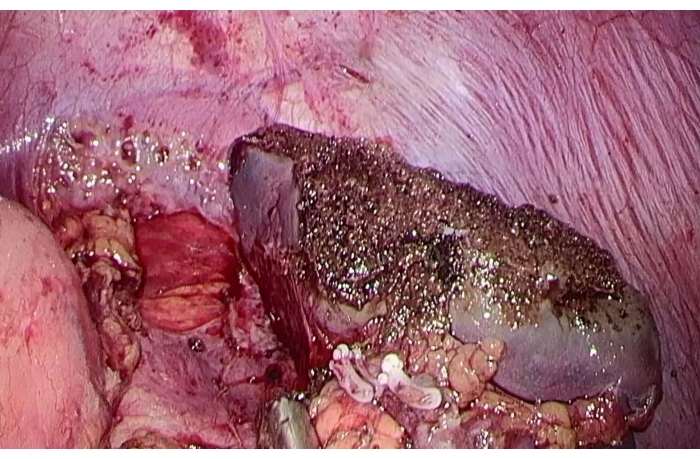 Surgical anatomy: liver cross-section, highlighting tissue structures, medical study, human organ analysis.