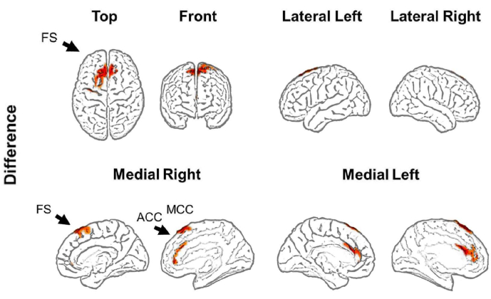 Brain fMRI results diagram; frontal lobe activation; comparative analysis; six brain views.