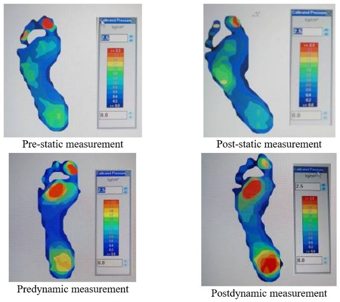 figure-results-2 Foot pressure analysis; dynamic/static measurement; heat map; biomechanical assessment diagram.