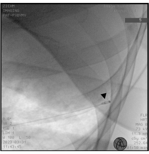 Fluoroscopy of vascular structure, radiological image, showing catheter placement for diagnostic use.