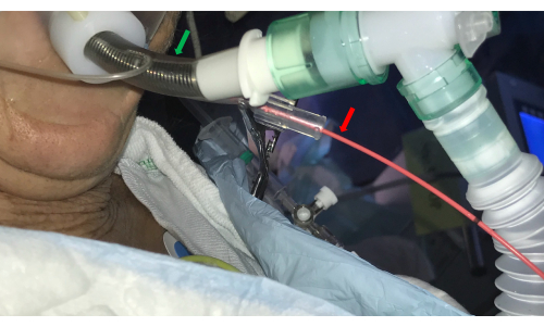 Medical intubation process with ventilator; diagram showing respiratory support setup.