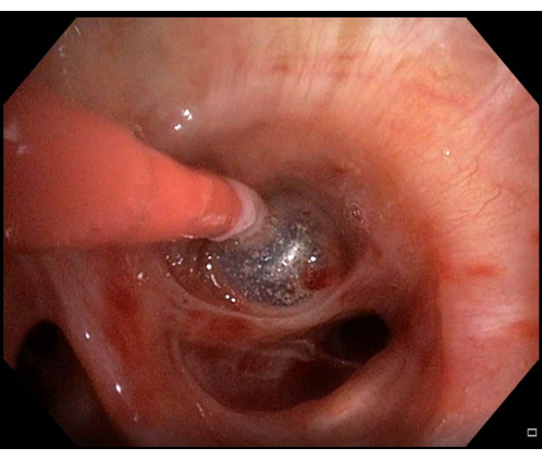 Endoscopic surgery procedure; bronchial tube visualization and surgical instrument insertion.