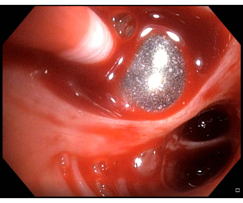 Endoscopic image, gastrointestinal tract, study of bleeding source, medical examination process.