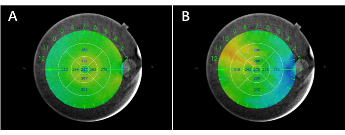 Corneal topography maps, ophthalmic diagnostic method for curvature analysis and vision assessment.