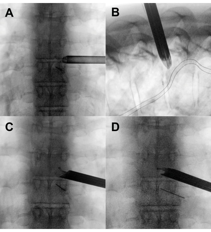 figure-results-1 Spine procedure diagram; fluoroscopy-guided needle insertion for epidural or nerve block.