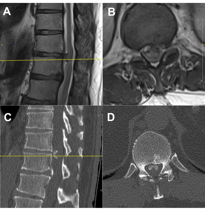 figure-results-2 MRI and CT scans showing spinal structure, sagittal and axial views; diagnostic imaging comparison.