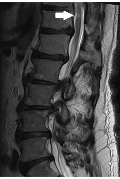 figure-results-3 MRI lumbar spine, sagittal view; arrow indicates disc herniation. Diagnostic imaging, neurology.
