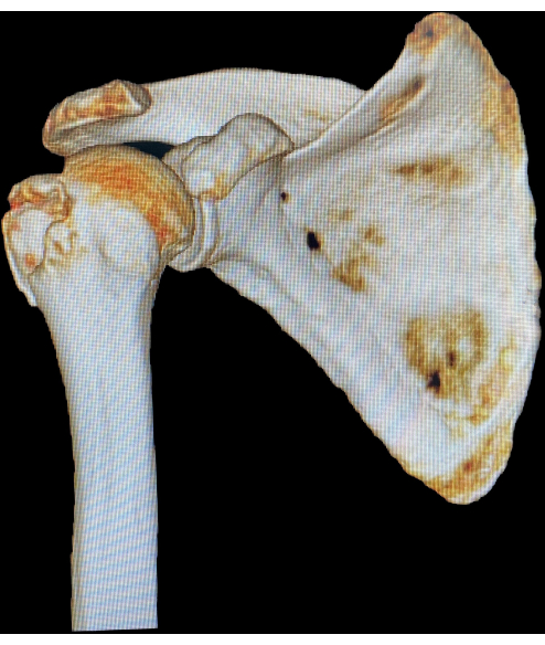 figure-results-1 Human shoulder bone structure, 3D visualization, anatomical study, skeletal diagram, orthopedic analysis.