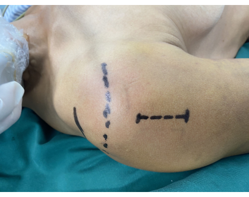 figure-results-2 Shoulder surgery pre-op markings; preparation for arthroscopic procedure; clinical setting.