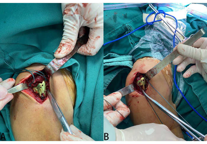 figure-results-3 Surgical procedure on knee joint showing implant placement and alignment with measurement tools.