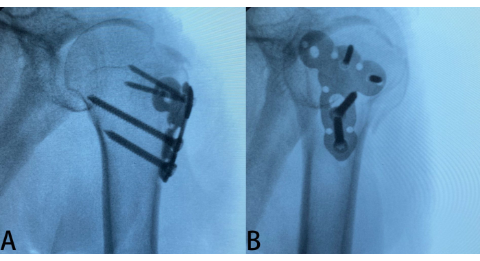 figure-results-4 Hip fracture repair comparison, X-ray diagram of surgical implants in femur stabilization.