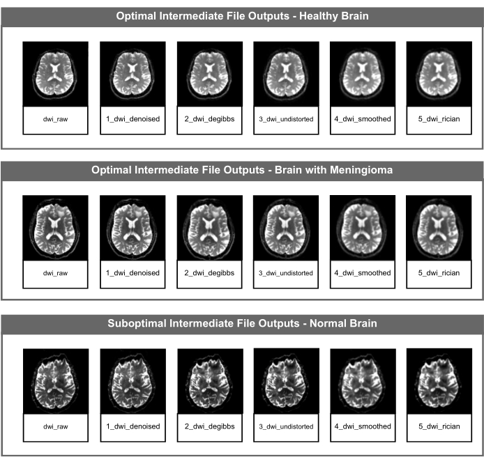 figure-results-2 Brain MRI processing stages; healthy, meningioma, normal brain analysis comparison.