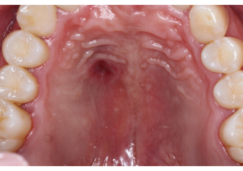 Dental anatomy, human palate structure, oral health diagram, close-up teeth alignment, gingiva.