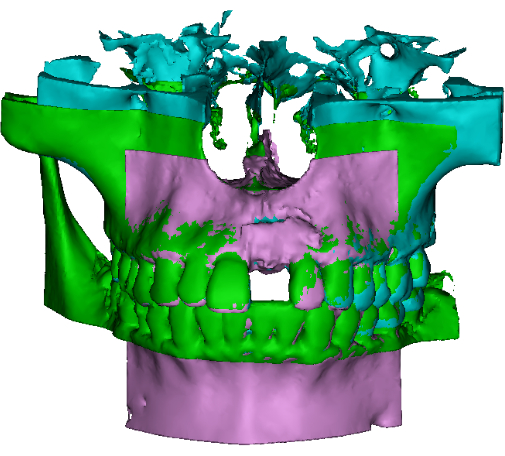 3D maxillofacial reconstruction diagram; CT scan for jaw anatomy and dental analysis.