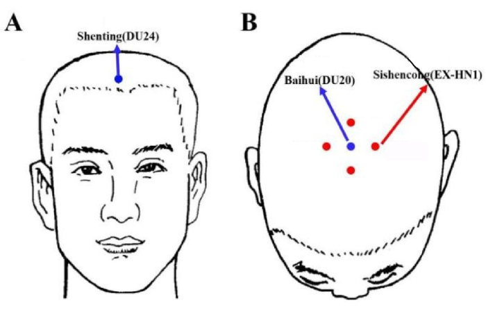 figure-results-1 Acupuncture point diagram, Shenting DU24, Baihui DU20, Sishencong EX-HN1, head illustration.
