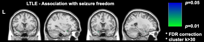 figure-introduction-2 Brain MRI analysis showing LTLE and seizure freedom; FDR correction; statistical data map; p-values.