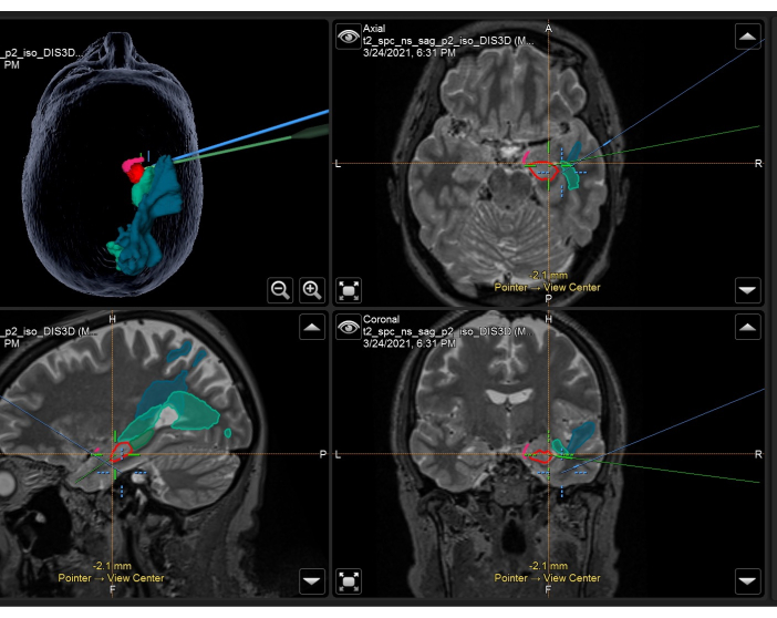Brain imaging; surgical planning; 3D MRI scans; axial, sagittal, coronal views; tumor mapping.