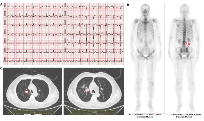 figure-results-3 ECG chart, CT scan, and bone scan image analysis for cardiac and skeletal assessment.