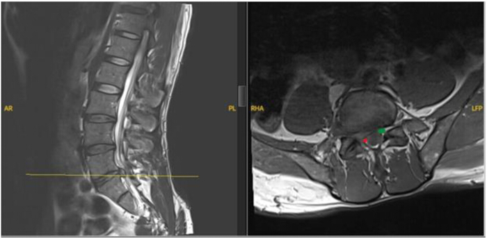 figure-introduction-3 MRI scan: Lumbar spine sagittal and axial views, diagnostic imaging of spinal structures.