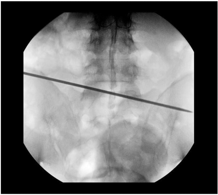 Fluoroscopy image showing spinal needle placement for epidural anesthesia procedure.