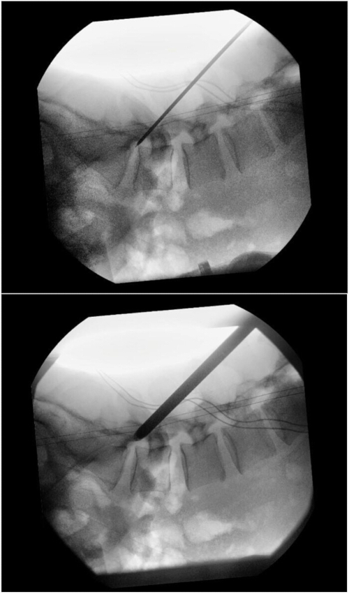 Spinal needle placement under fluoroscopy; medical imaging technique; interventional procedure guide.