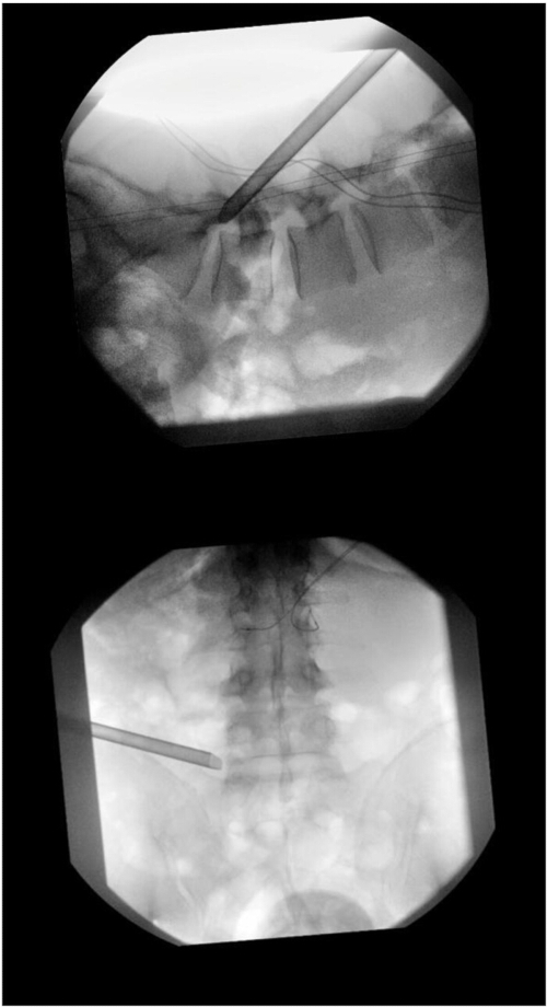 Spinal imaging, X-ray technique; needle insertion, fluoroscopy, medical procedure, diagnostic view.