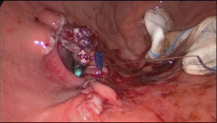 Endoscopic image of a gastric variceal ligation procedure illustrating hemostatic intervention.