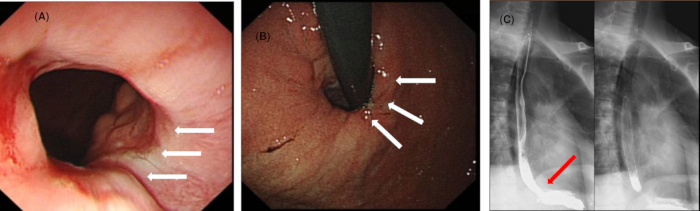 Endoscopic and X-ray imaging in gastroenterology; esophageal examination and foreign body detection.