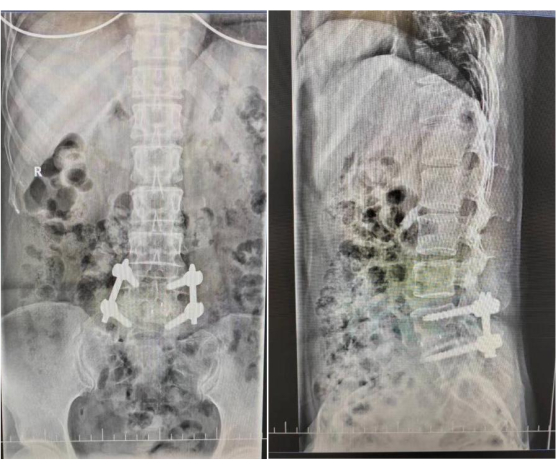 X-ray imaging of spinal fixation, orthopedic surgical result, anterior and lateral views, spine.