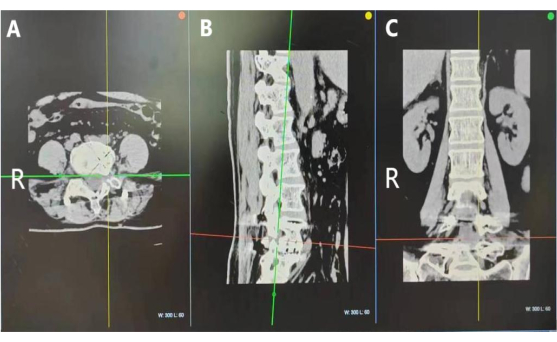 CT scan showing lumbar spine in axial, sagittal, coronal views; radiographic diagnostic method.