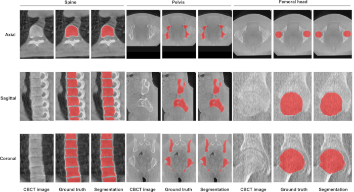 CBCT image analysis; axial, sagittal, coronal views; spine, pelvis, femoral head segmentation diagram.