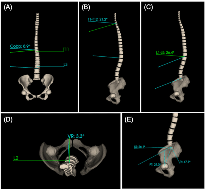 Spinal curvature diagrams with Cobb angles and vertebral rotations for scoliosis analysis.