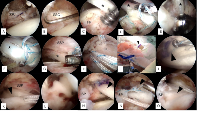 figure-results-2 Arthroscopic rotator cuff repair, surgical procedure steps, visual guide, medical technique.