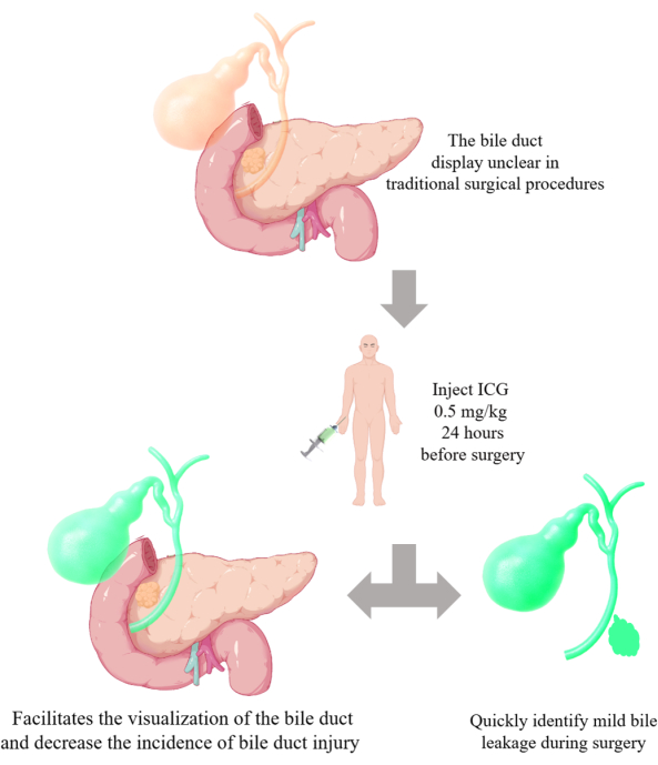 Bile duct visualization with ICG injection; surgical enhancement diagram for bile injury reduction.