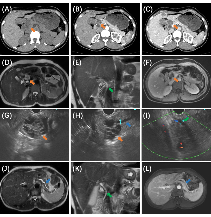 CT and MRI scan series showing pancreas imaging, tumor identification, and diagnostic assessment.