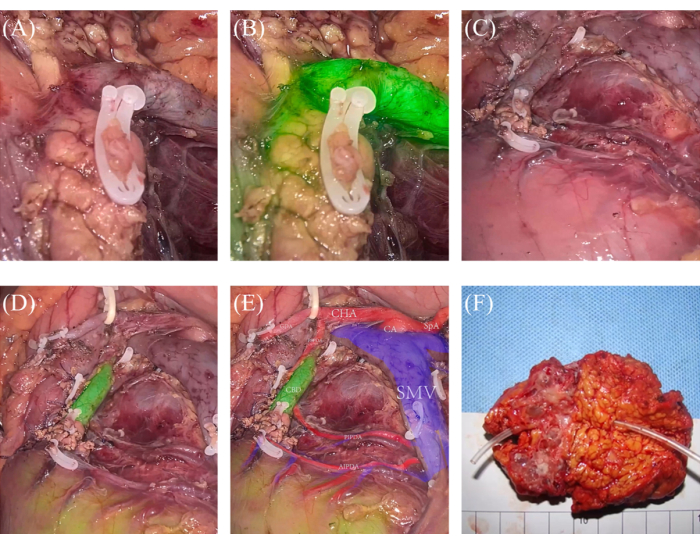Surgical resection process; labeled anatomical structures; medical study; steps A-F shown.