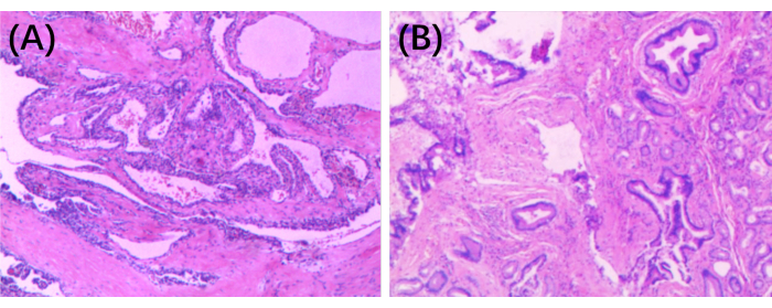Histology slide comparison of tissue samples (A) and (B), visible cellular structures, microscopic image.