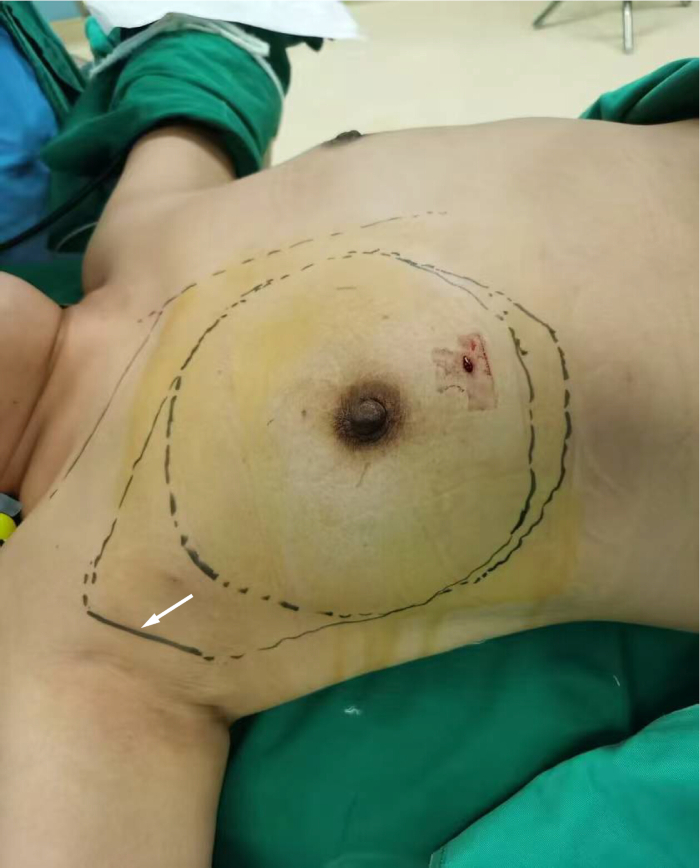 Surgical markings on male chest for gynecomastia correction procedure, showing incision lines.