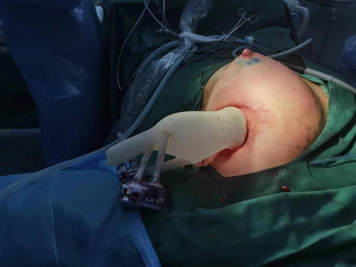 Surgical procedure using robotic arm in operating room, emphasizing advanced medical technology.