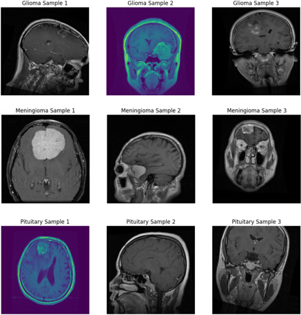 figure-protocol-1 MRI brain scans showing glioma, meningioma, and pituitary tumors; diagnostic imaging analysis.